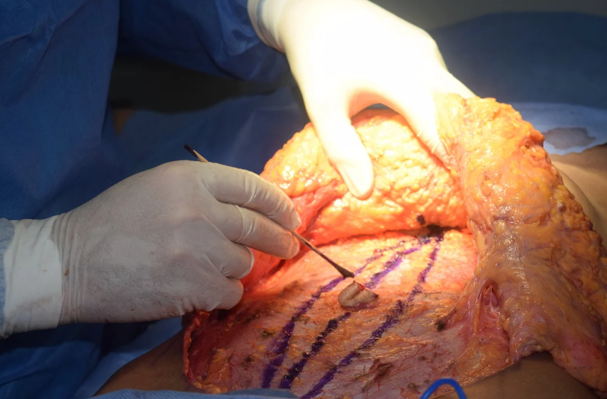 tummy tuck